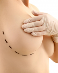 Mamoplastia Redutora - Dr. Simão Sereno